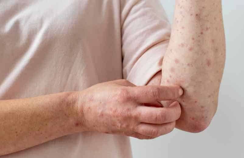 Boutons de la variole du singe : à quoi ils ressemblent et quel traitement suivre aujourd’hui ? IRASF Santé