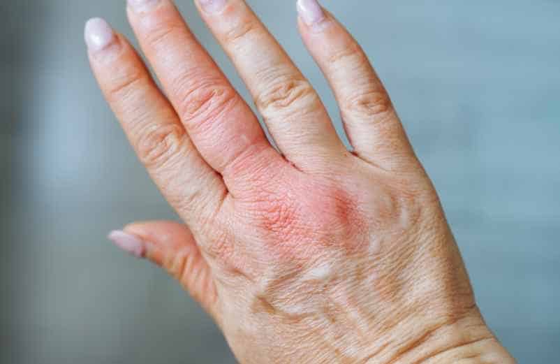 Analyser les causes probables de la raideur et de l’œdème-IRASF Santé Analyser les causes probables de la raideur et de l’œdème-IRASF Santé