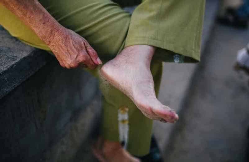 Pied qui brûle : causes possibles et remèdes de grand-mère IRASF Santé